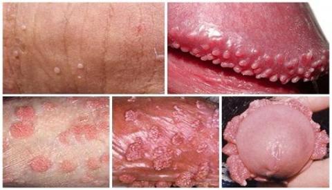 Nổi mụn ở dương vật – Dấu hiệu cảnh báo bệnh nguy hiểm