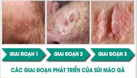 Các giai đoạn phát triển của bệnh sùi mào gà nữ