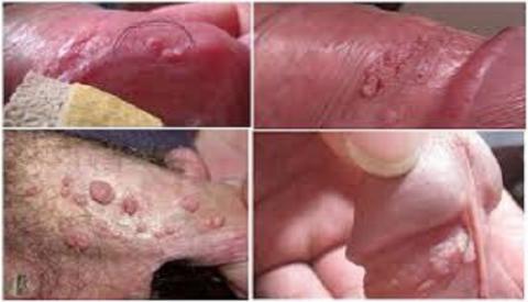 Biểu hiện của bệnh sùi mào gà ở nam giới