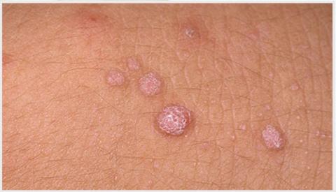 Cách nhận biết bệnh sùi mào gà ở nam giới giai đoạn đầu