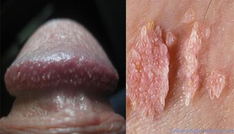 Bệnh sùi mào gà ở nam giới nguy hiểm như thế nào