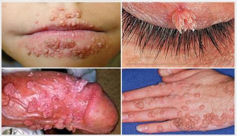 Thời gian phát bệnh sùi mào gà là bao lâu?