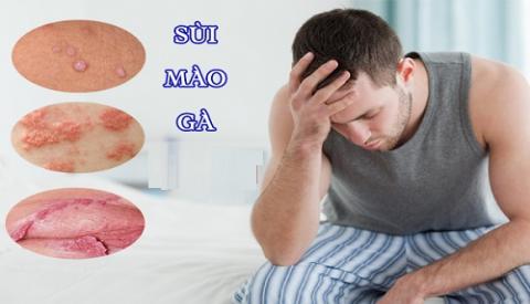 Giai đoạn đầu của bệnh sùi mào gà có biểu hiện như thế nào?