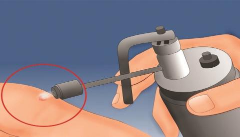 Đốt laser sùi mào gà hết bao nhiều tiền?