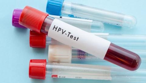 Những điều cần biết về xét nghiệm HPV