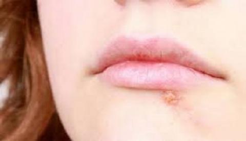 Hiện tượng bệnh s&ugrave;i m&agrave;o g&agrave; ở nữ - bệnh x&atilde; hội nguy hiểm
