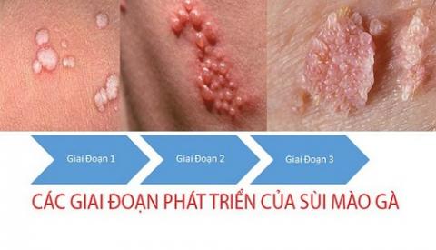 Bệnh s&ugrave;i m&agrave;o g&agrave; ở nữ giai đoạn đầu nguy hiểm như thế n&agrave;o?