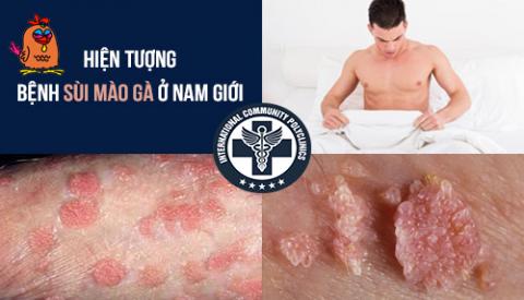Hiện tượng bệnh s&ugrave;i m&agrave;o g&agrave; ở nam giới &ndash; cảnh b&aacute;o bệnh x&atilde; hội nguy hiểm