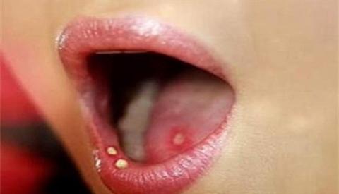 Bệnh lậu ở miệng &ndash; bệnh x&atilde; hội nguy hiểm