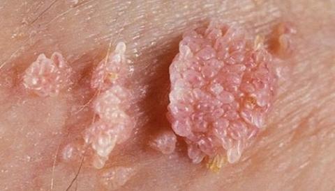 C&aacute;ch chữa bệnh s&ugrave;i m&agrave;o g&agrave; ở nam tại nh&agrave;