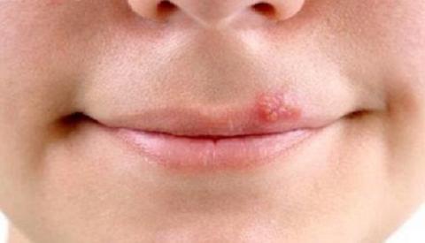 C&aacute;ch chữa bệnh s&ugrave;i m&agrave;o g&agrave; ở nữ tại nh&agrave;