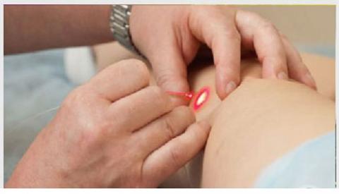 Đốt điện s&ugrave;i m&agrave;o g&agrave; c&oacute; đau kh&ocirc;ng