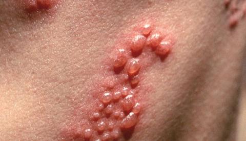 Mụn nước sinh dục – Căn bệnh nguy hiểm, chớ dại chủ quan