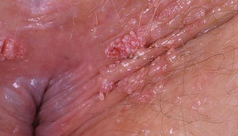 S&ugrave;i m&agrave;o g&agrave; ở hậu m&ocirc;n&nbsp;