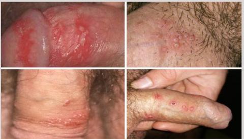 Phương pháp điều trị mụn nước sinh dục nam hiệu quả