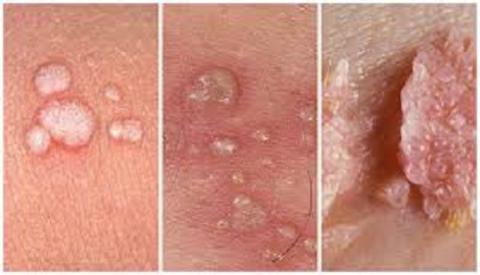 Thời gian ủ bệnh của s&ugrave;i m&agrave;o g&agrave;