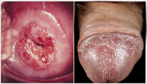 Điều trị s&ugrave;i m&agrave;o g&agrave; mất bao nhi&ecirc;u thời gian th&igrave; khỏi bệnh?