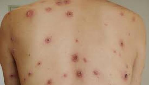 Tìm hiểu về dấu hiệu bệnh giang mai điển hình