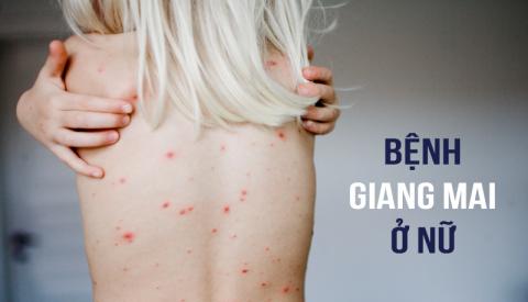 Bệnh giang mai ở nữ - bệnh hủy hoại cuộc đời người phụ nữ.