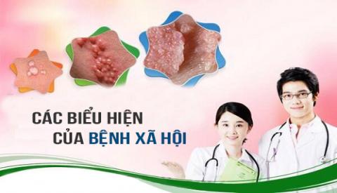 Dấu hiệu bệnh xã hội người bệnh cân lưu ý.