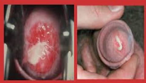 Chảy mủ bộ phận sinh dục &ndash; Dấu hiệu cảnh b&aacute;o nguy hiểm