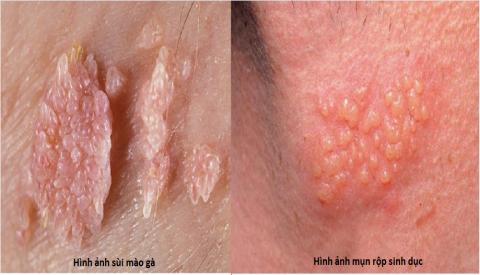 Nguyên nhân gây mụn ở bộ phận sinh dục và cách điều trị triệt để