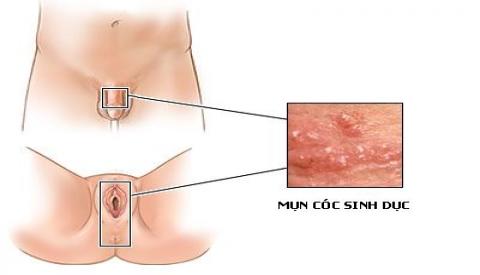 Mụn cóc ở vùng kín – dấu hiệu của nhiều bệnh lý nguy hiểm chớ được xem thường