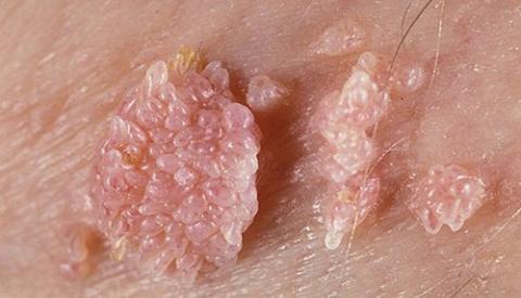 Dễ dàng nhận biết dấu hiệu khi mắc sùi mào gà ở nữ