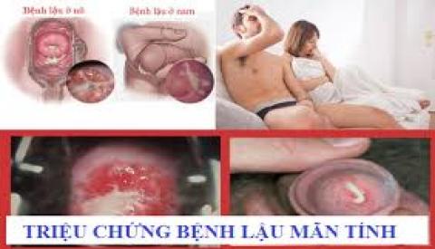 Biểu hiện của bệnh lậu mãn tính mà bạn nên biết