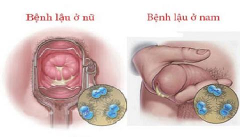 Dấu hiệu nhận biết bệnh lậu