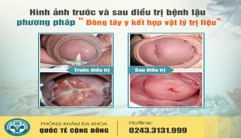 C&aacute;ch chữa bệnh lậu ở nữ giới hiệu quả, ngăn ngừa t&aacute;i ph&aacute;t