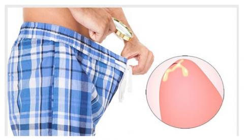 Cảnh báo nguy hiểm: Chảy mủ ở dương vật chưa chắc đã là bệnh lậu